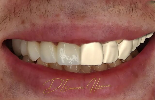 Full Upper Jaw Rehabilitation