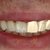 Full Upper Jaw Rehabilitation