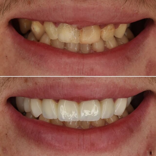 3D model of Full Upper Jaw Rehabilitation