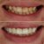 Full Upper Jaw Rehabilitation