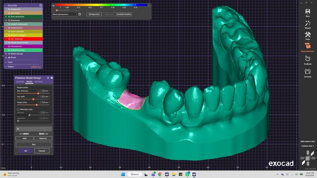 My cases | Exocad Dental CAD/CAM Portfolio – image 6 of 7