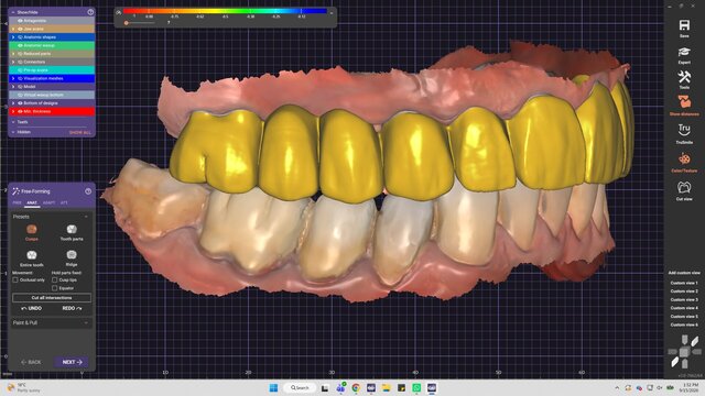 My cases | Exocad Dental CAD/CAM Portfolio – image 4 of 7
