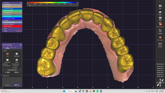 My cases | Exocad Dental CAD/CAM Portfolio – image 3 of 7