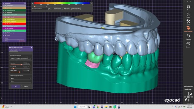 My cases | Exocad Dental CAD/CAM Portfolio – image 7 of 7