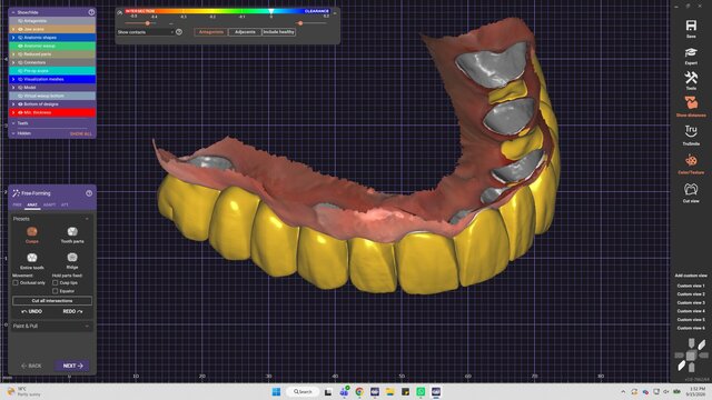 My cases | Exocad Dental CAD/CAM Portfolio – image 2 of 7