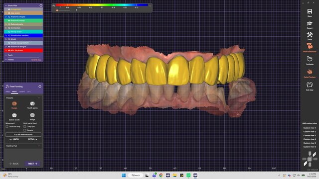 My cases | Exocad Dental CAD/CAM Portfolio – image 5 of 7