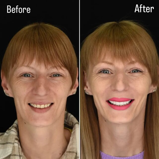 3D model of Full Uper Jaw Rehabilitation