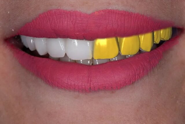 Full Uper Jaw Rehabilitation
