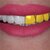 Full Uper Jaw Rehabilitation