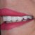 Full Uper Jaw Rehabilitation