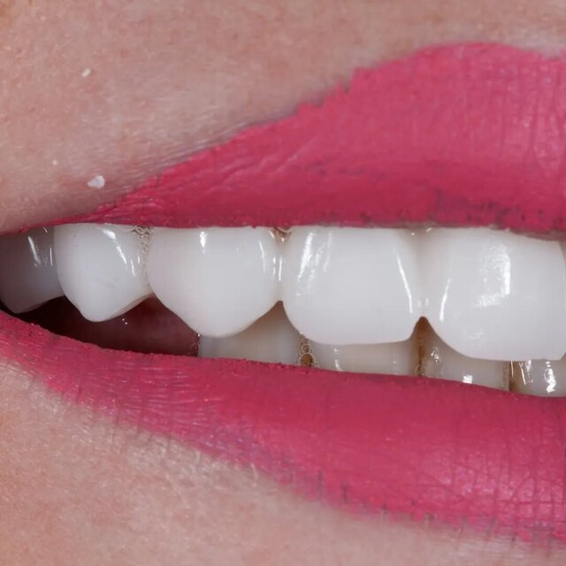 3D model of Full Uper Jaw Rehabilitation