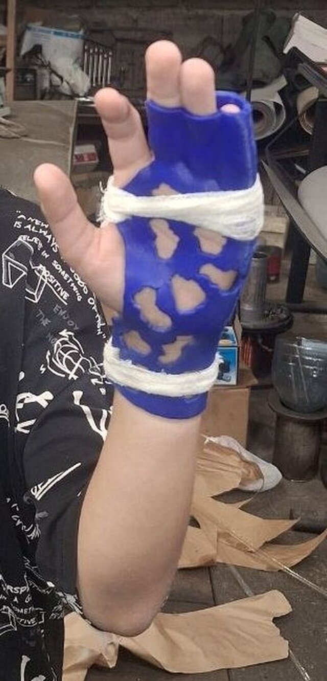 Custom 3D-Printed Orthosis from 3D Scan for a Child’s Hand (Left Hand)