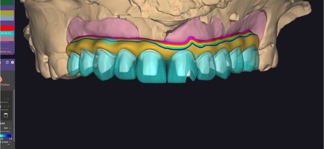 full-arch