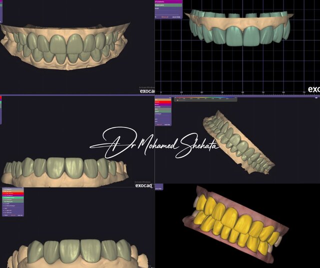 I will design professional Exocad dental restorations, implant cases and full arch workflows
